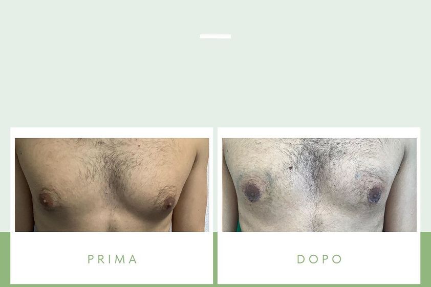 Ginecomastia prima e dopo - 849982