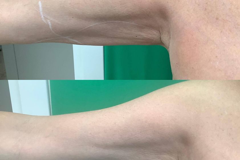 Laserlipolisi prima e dopo - 873467