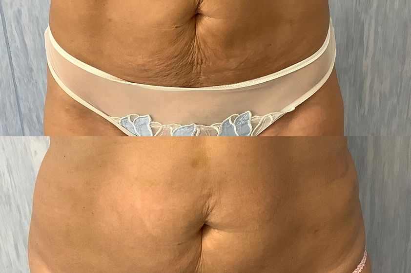 Laserlipolisi prima e dopo - 873469