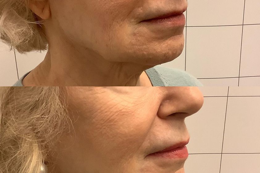 Lifting viso prima e dopo - 873473