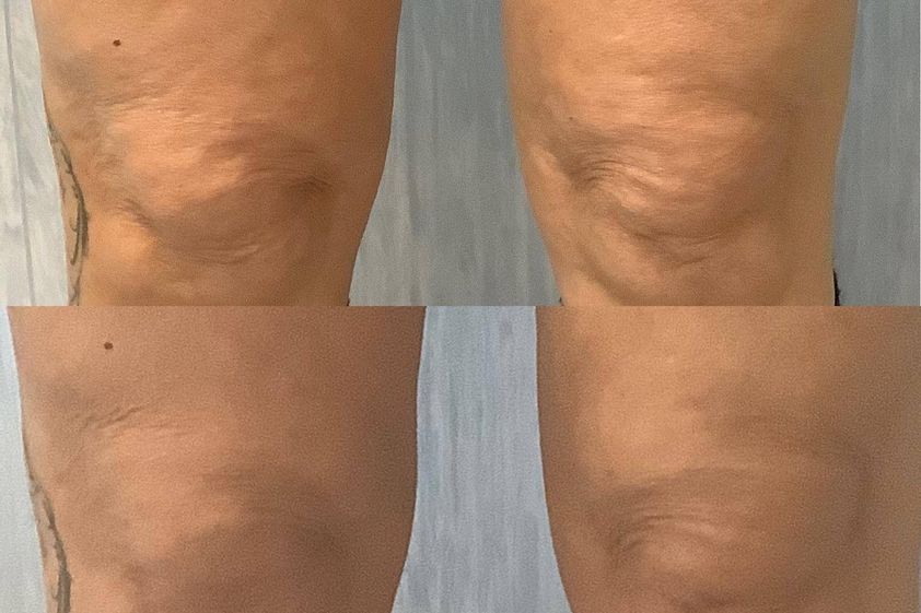 Laserlipolisi prima e dopo - 873474