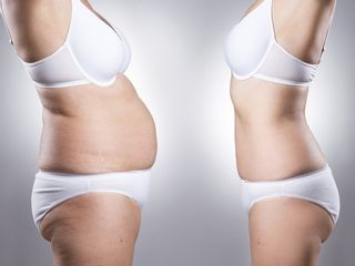 Liposuzione addome