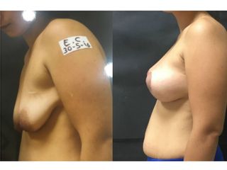 Mastopessi prima e dopo