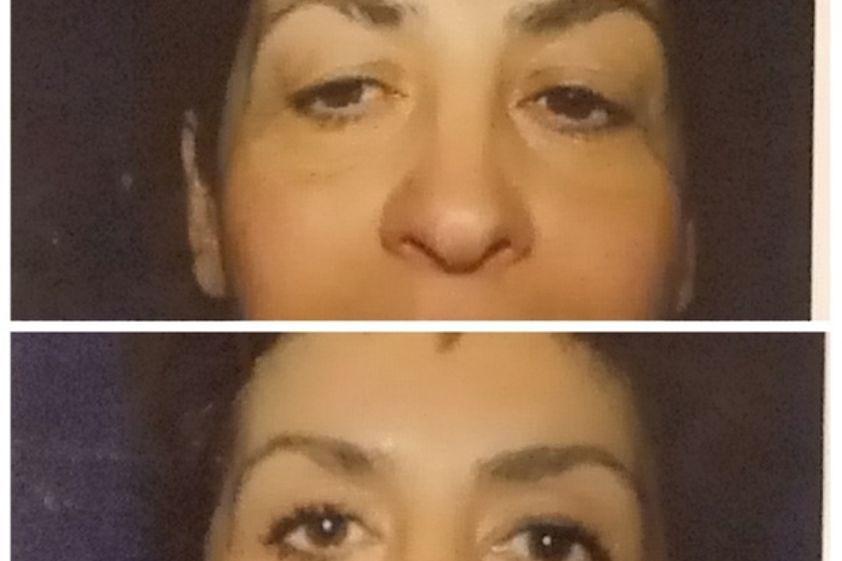 Blefaroplastica prima e dopo - 760068