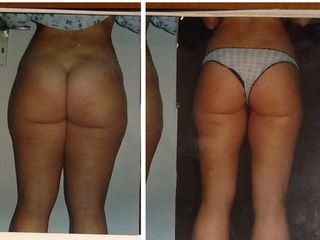 Liposcultura prima e dopo