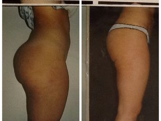 Liposuzione prima e dopo