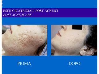 Cicatrici acne prima e dopo