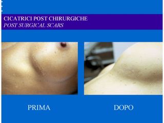 Cicatrici prima e dopo