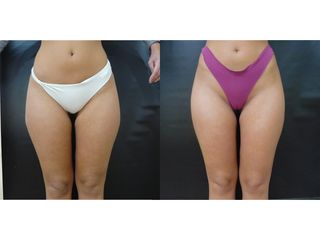 Liposcultura prima e dopo