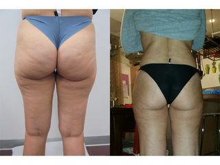 Liposcultura prima e dopo