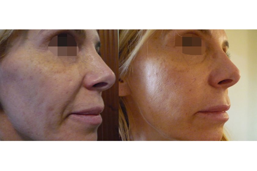 Lipofilling prima e dopo - 768358