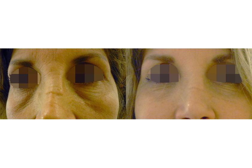 Lipofilling prima e dopo - 768359