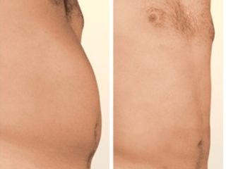 Liposuzione prima e dopo