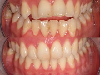 Ortodonzia prima e dopo