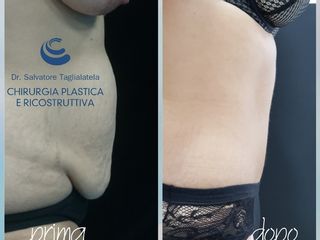 Addominoplastica prima e dopo