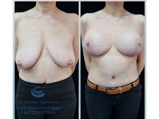 Mastopessi prima e dopo