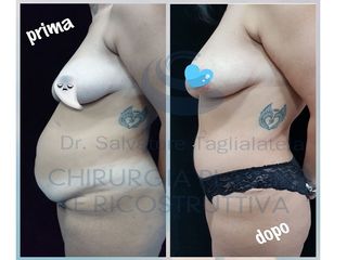 Addominoplastica prima e dopo