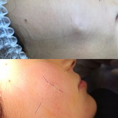 Rimozione Cisti - Dott. Gabriele Giuffrida