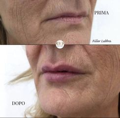 Filler labbra - Dott.ssa Serena De Felice