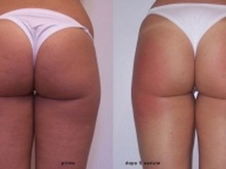 Gluteoplastica prima dopo