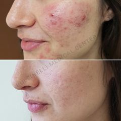 Acne - Pulsinelli Center