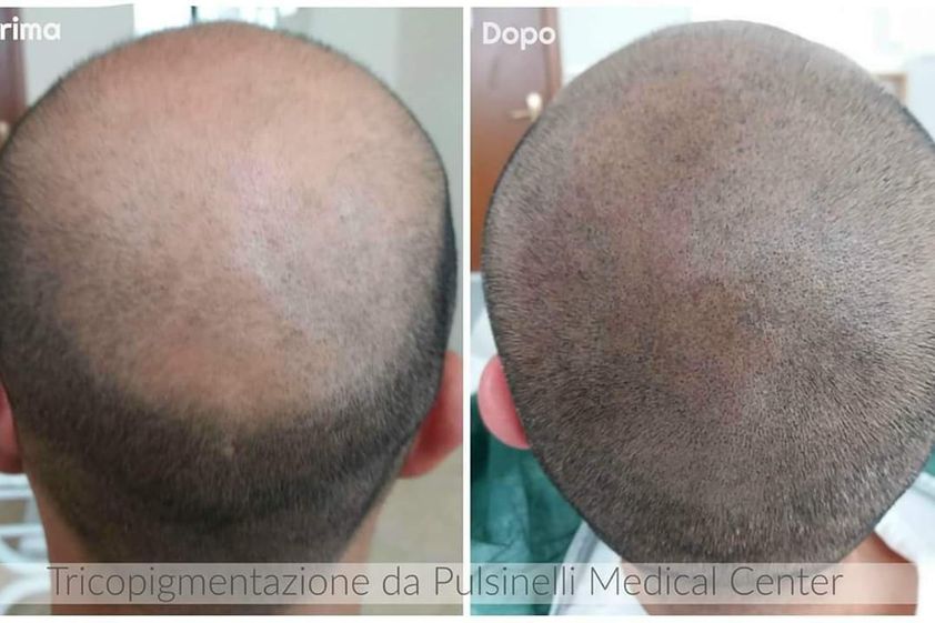 Dermopigmentazione prima e dopo - 808945