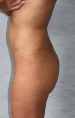 lifting con fili glutei pre intervento
