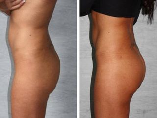 Gluteoplastica prima e dopo