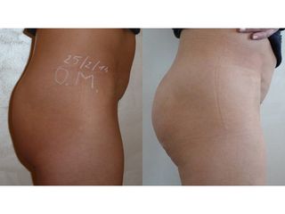 Gluteoplastica - Dott. Maurizio Berlanda
