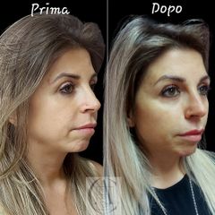 Filler - Dr.ssa Alessia Capozzi