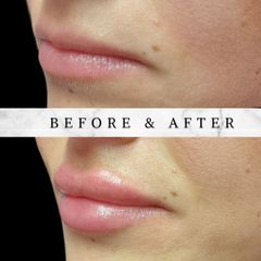 Filler labbra - Dr.ssa Alessia Capozzi