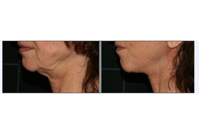 Lifting viso prima e dopo - 746607