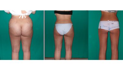 Liposuzione con dieta