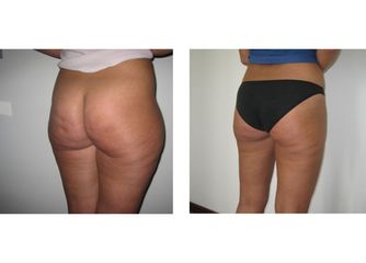 Lipoaspirazione prima dopo