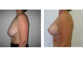 Mastopessi pre e post
