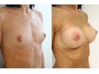 Mastoplastica additiva con protesi anatomiche