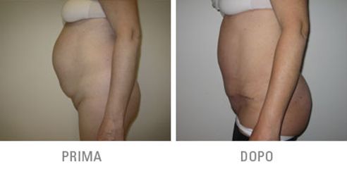 Addominoplastica prima dopo