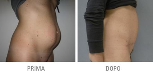 Addominoplastica prima dopo