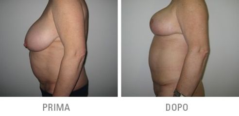 Addominoplastica prima dopo