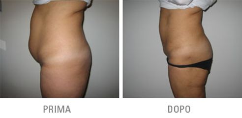 Lipoaspirazione addome prima dopo
