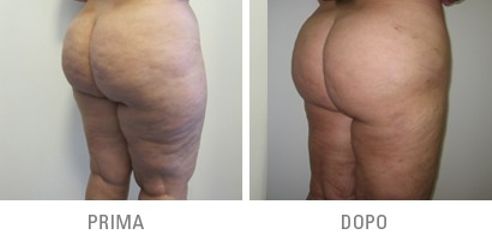 liposcultura prima dopo