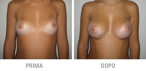 mastoplastica additiva prima dopo