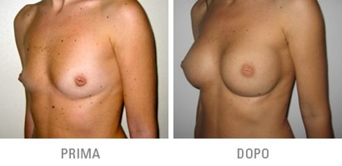 mastoplastica additiva prima dopo