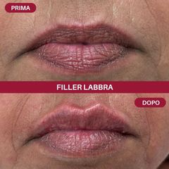 Filler labbra - Aori Medical