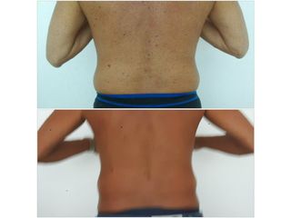 liposcultura prima dopo