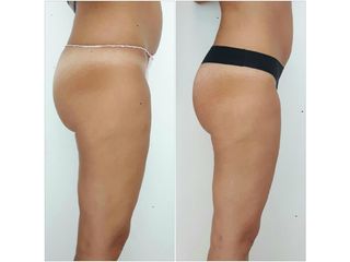 Gluteoplastica prima dopo