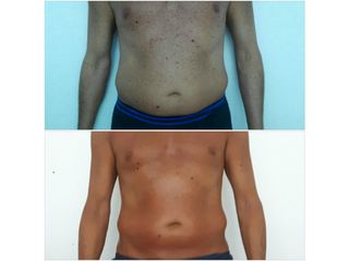 liposcultura prima dopo