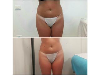 liposcultura prima dopo
