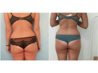 liposcultura prima dopo