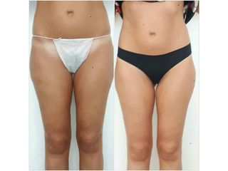 liposcultura prima dopo